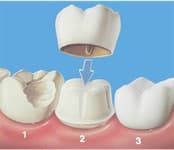 Постэндодонтическое восстановление зуба